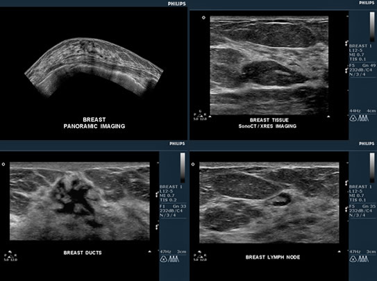 Breast Ultrasound * New York Medical Imaging * Diagnostic Radiology ...